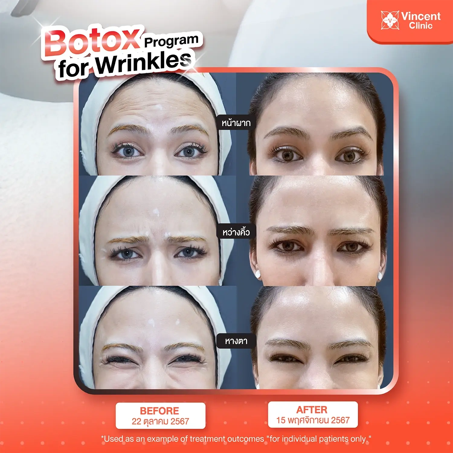 botox-program-wrinkle-reduction-1