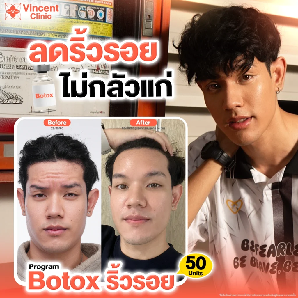 รีวิวฉีดโบท็อกริ้วรอยหน้าผาก