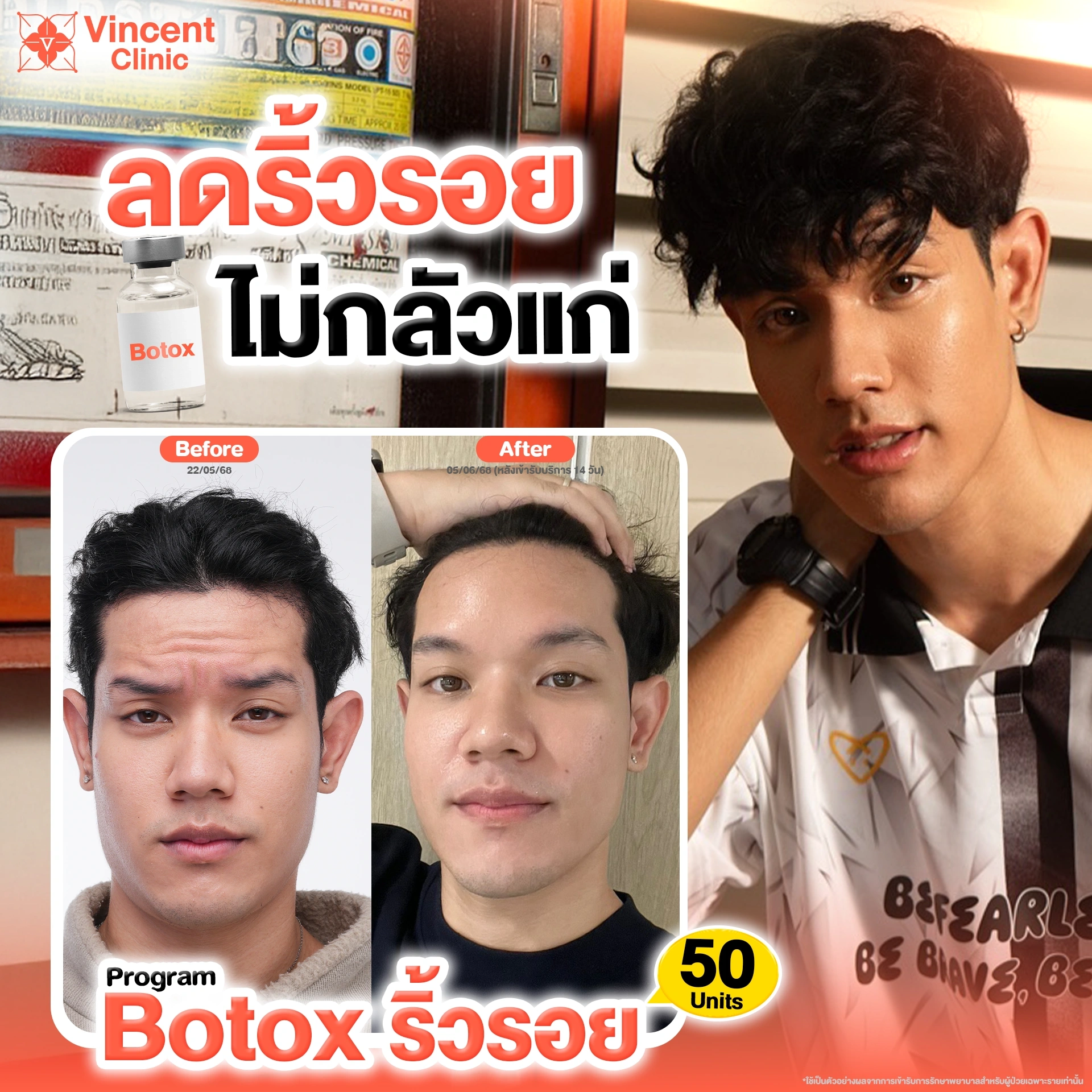 botox-wrinkle-review-men-vincent-clinic