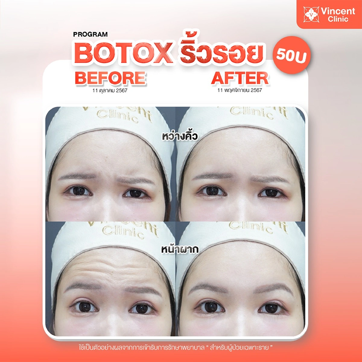 botox-wrinkle-review-vincent-clinic-02-1_1
