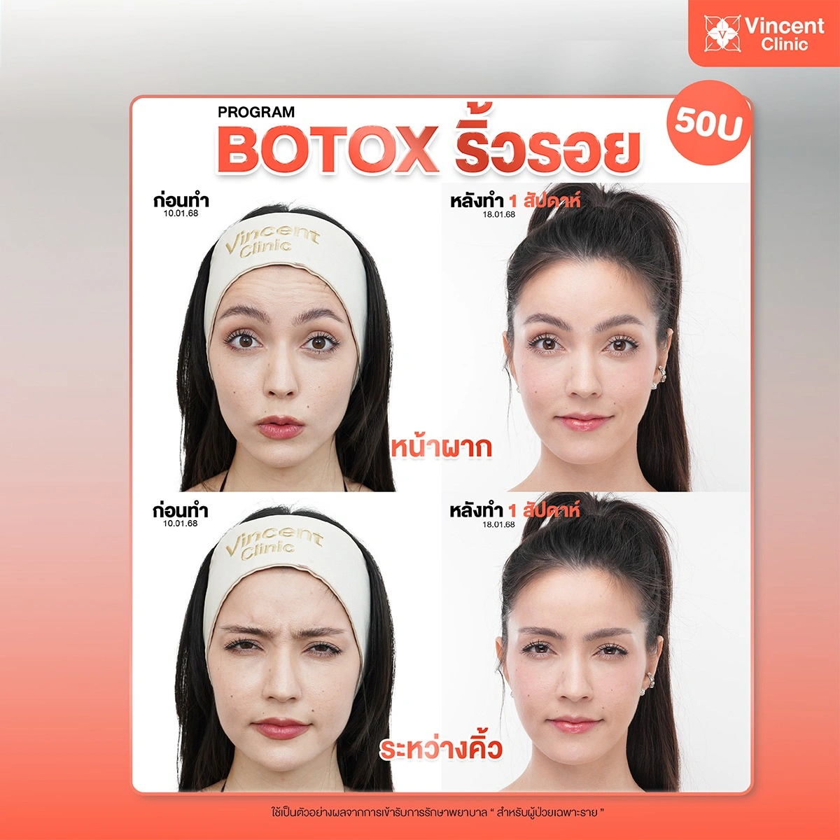 botox-wrinkle-review-vincent-clinic-03-1_1