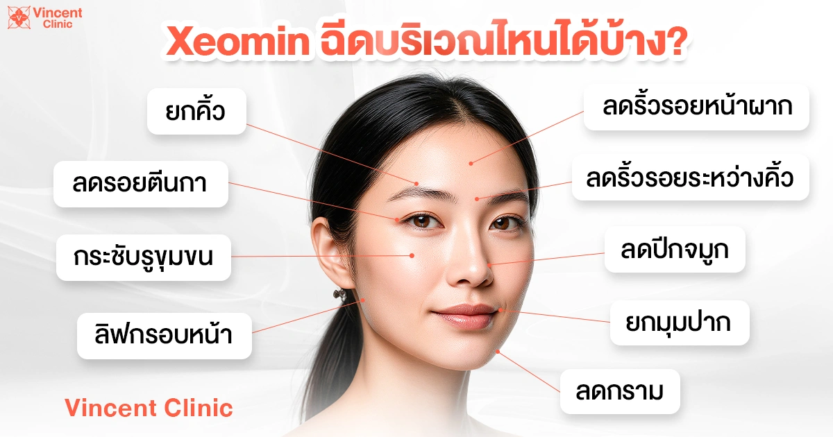 Where can Xeomin be injected? xeomin ฉีดตำแหน่งไหนได้บ้าง