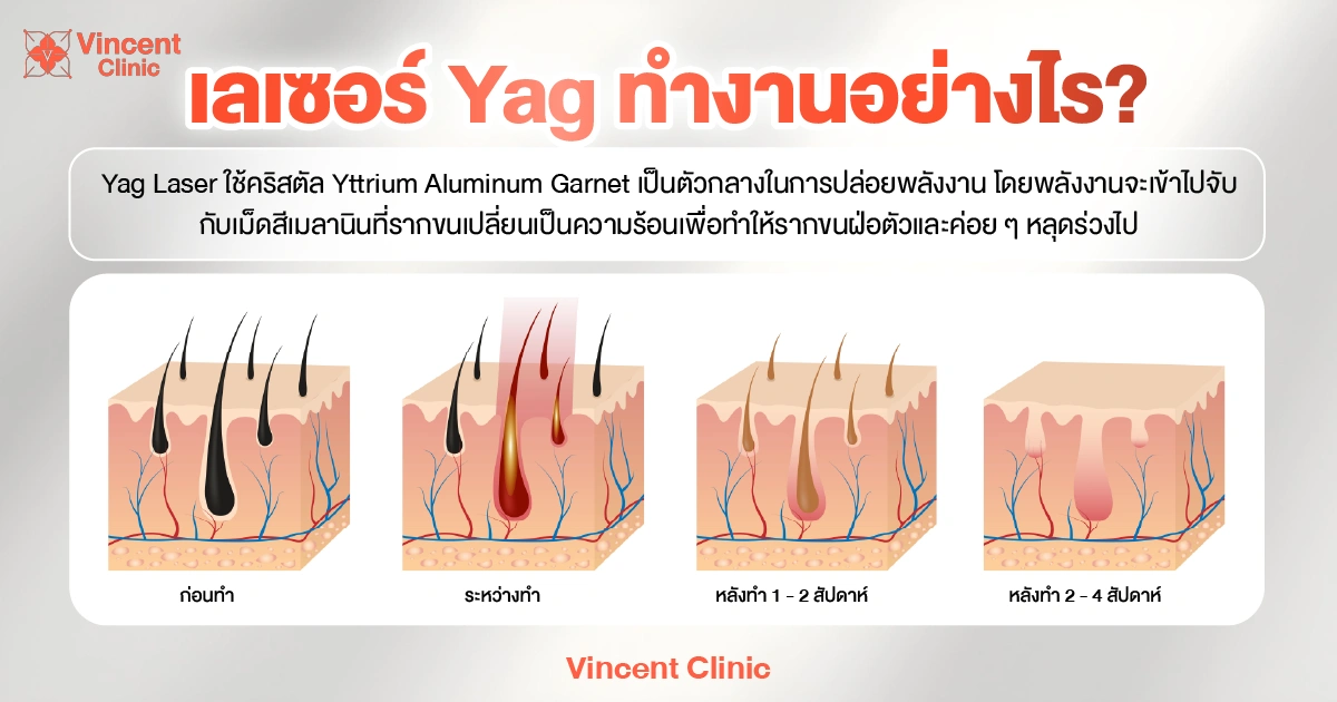 How does a Yag laser work? เลเซอร์ Yag ทำงานอย่างไร?