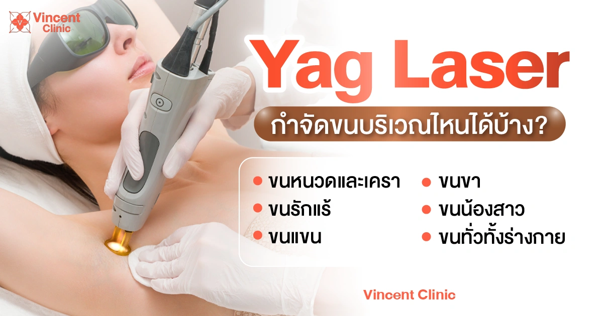Which areas can be treated with Yag Laser for hair removal? Yag Laser กำจัดขนบริเวณไหนได้บ้าง?