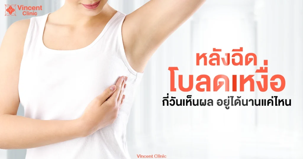 โบลดเหงื่ออยู่ได้นานแค่ไหน กี่วันเห็นผล