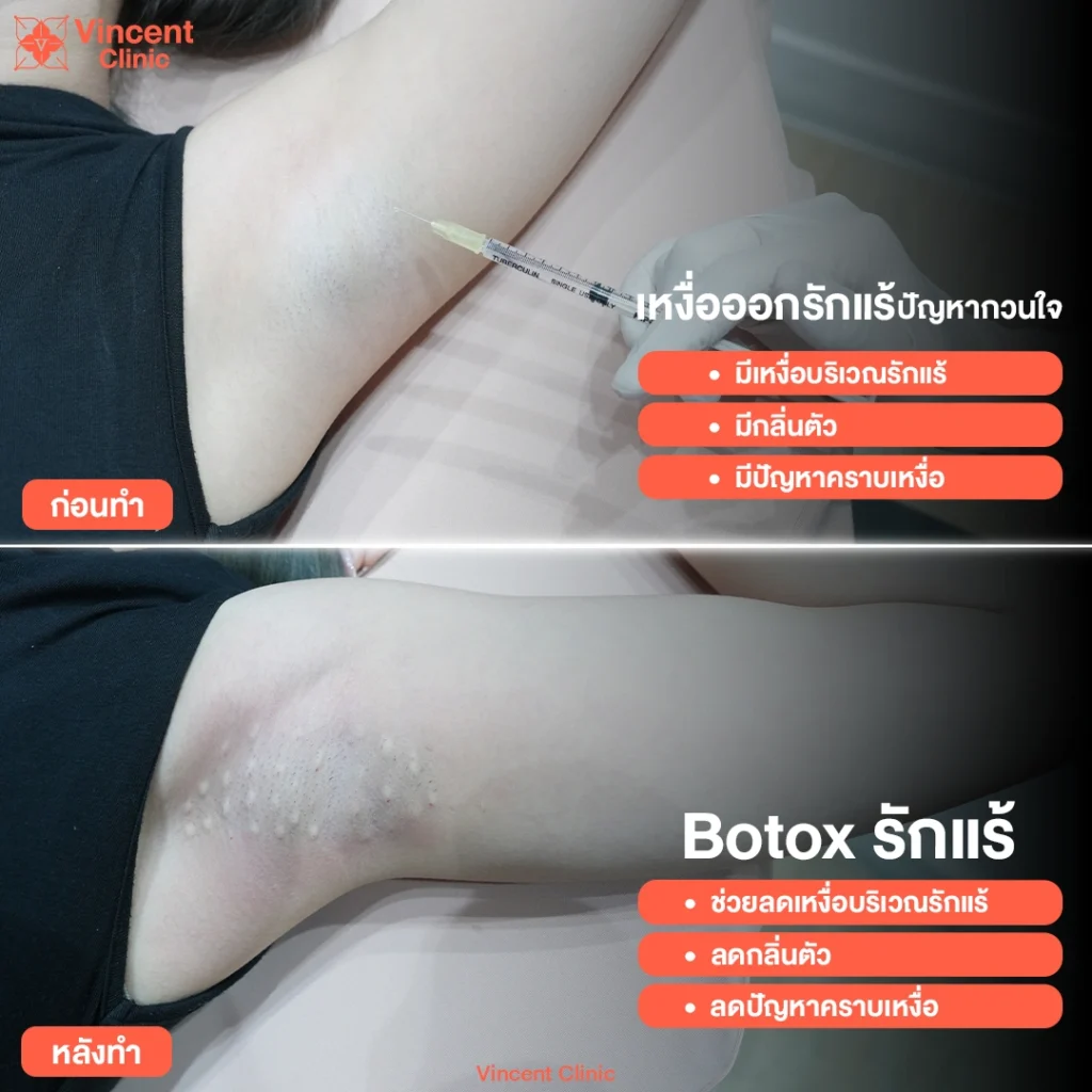 รีวิวโบท็อกรักแร้
