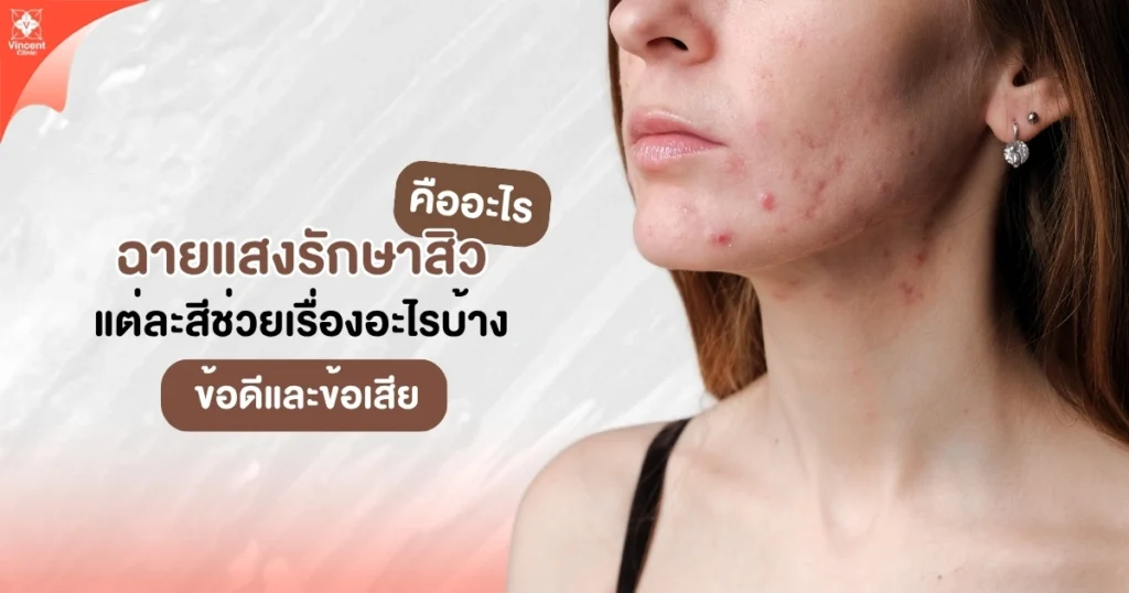 ฉายแสงรักษาสิว