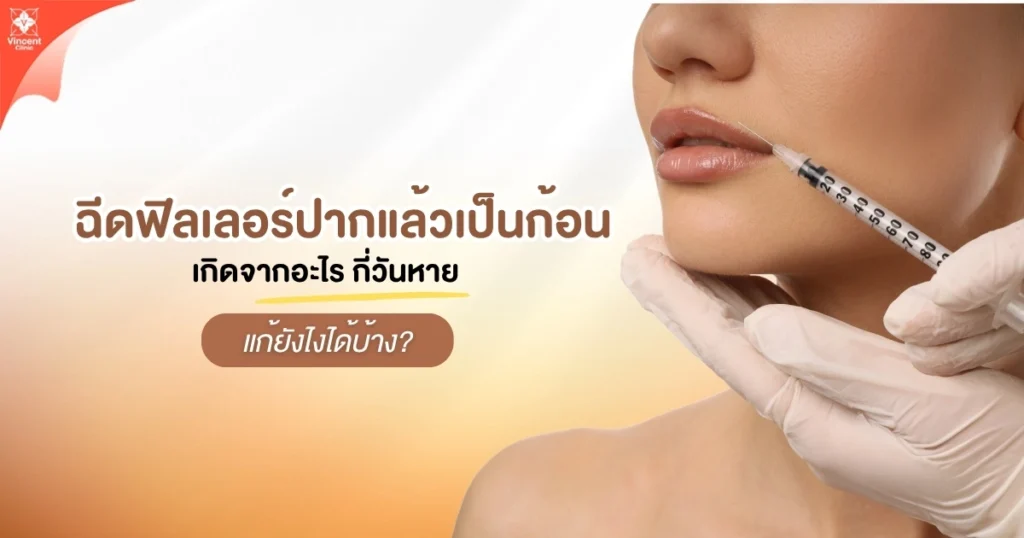 ฉีดฟิลเลอร์แล้วปากเป็นก้อน