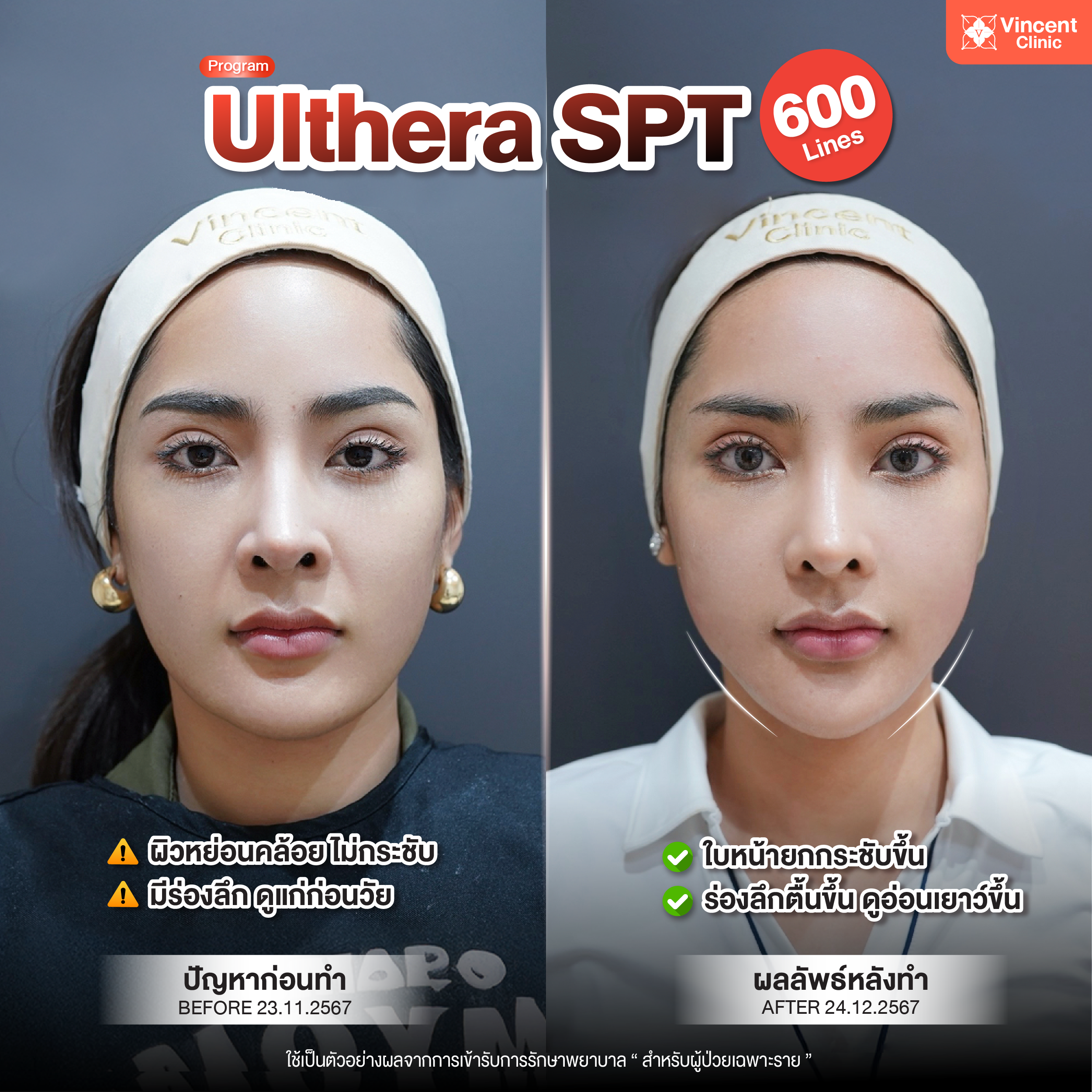 Ulthera SPT รีวิว