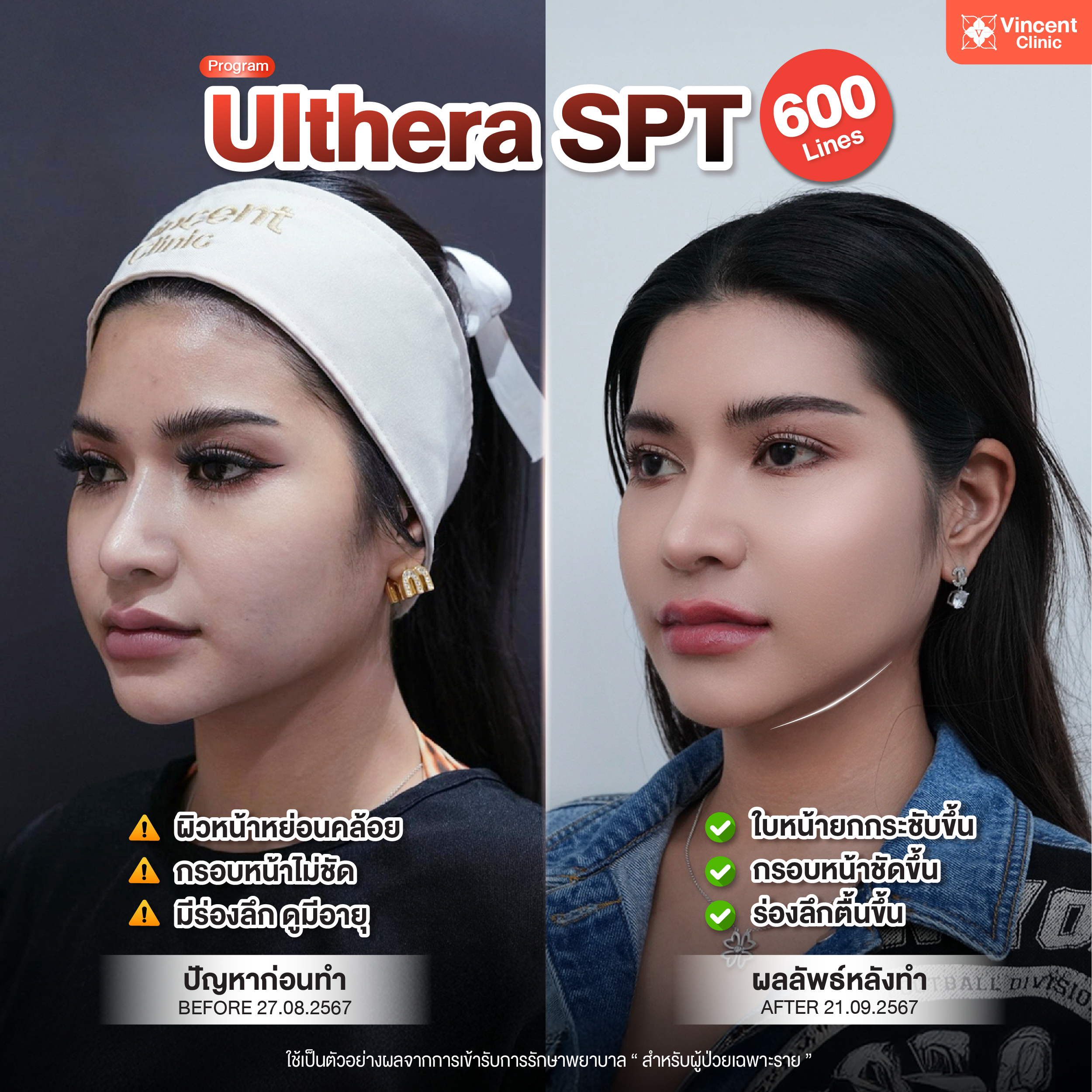 รีวิวทำ Ulthera SPT
