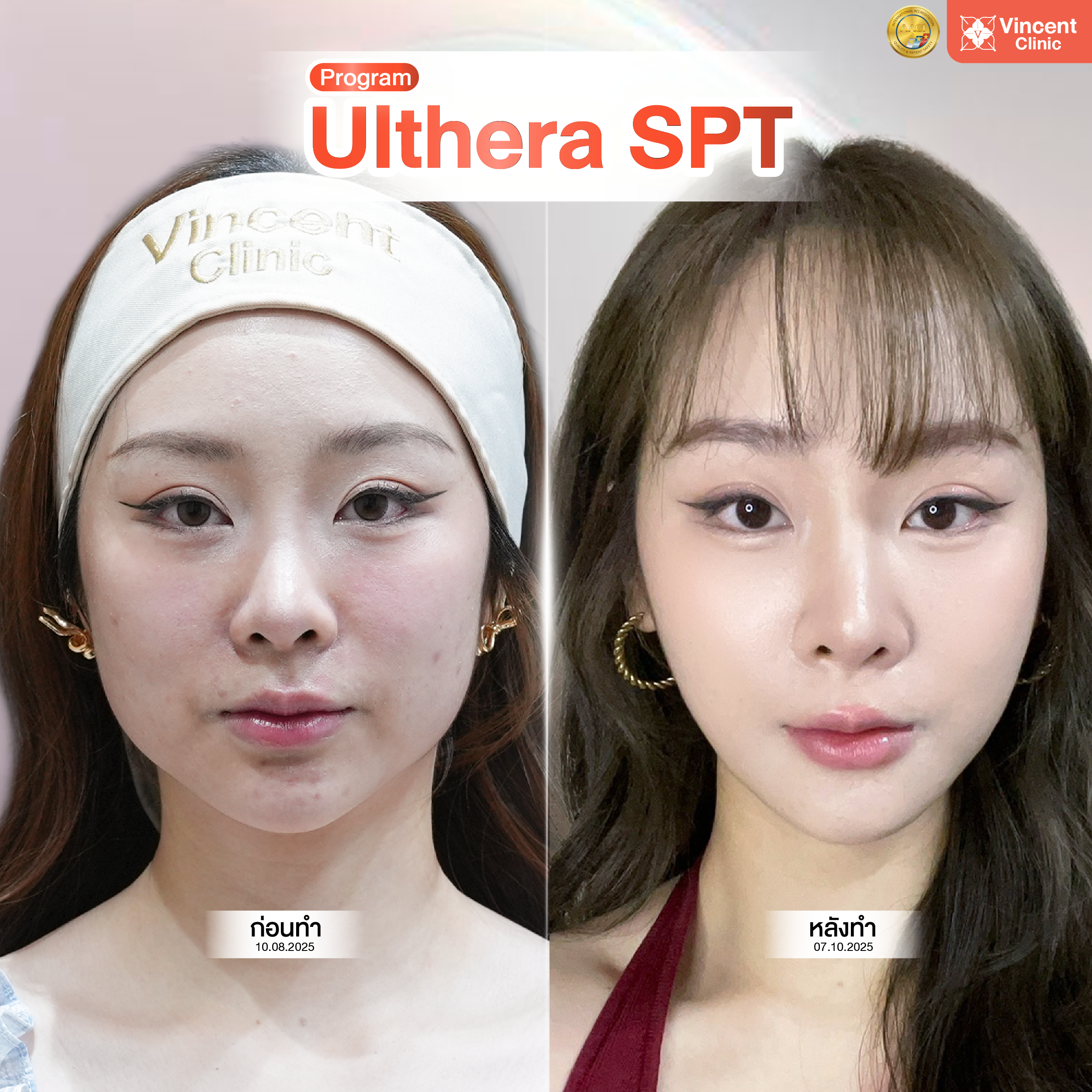 เครื่องยกกระชับ Ulthera รีวิว