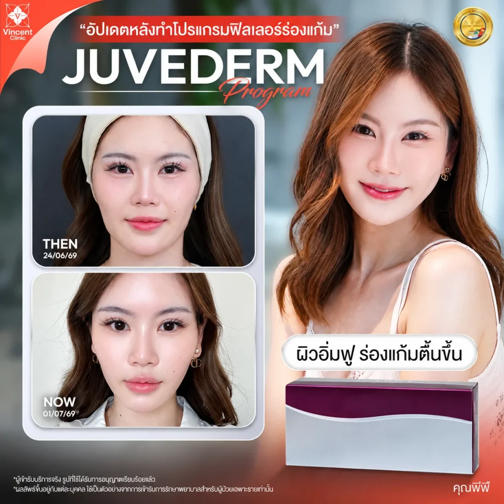 รีวิวฟิลเลอร์ Juvederm