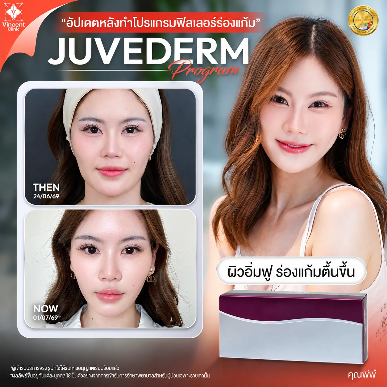 รีวิวฟิลเลอร์ Juvederm