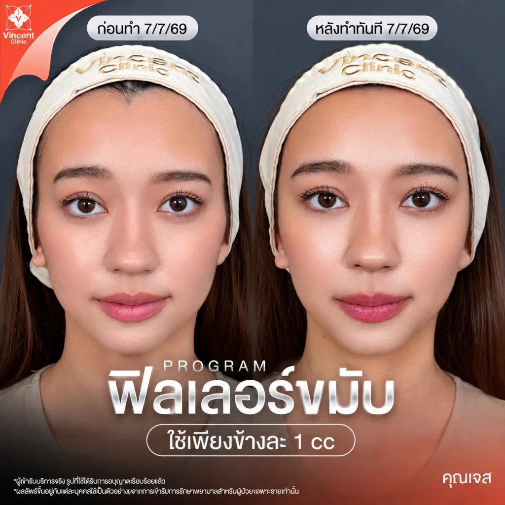รีวิวฟิลเลอร์ขมับ