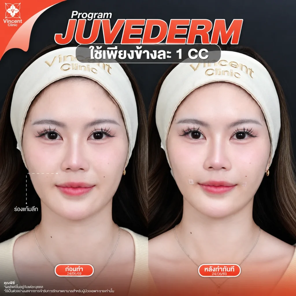 รีวิวฟิลเลอร์ juvederm