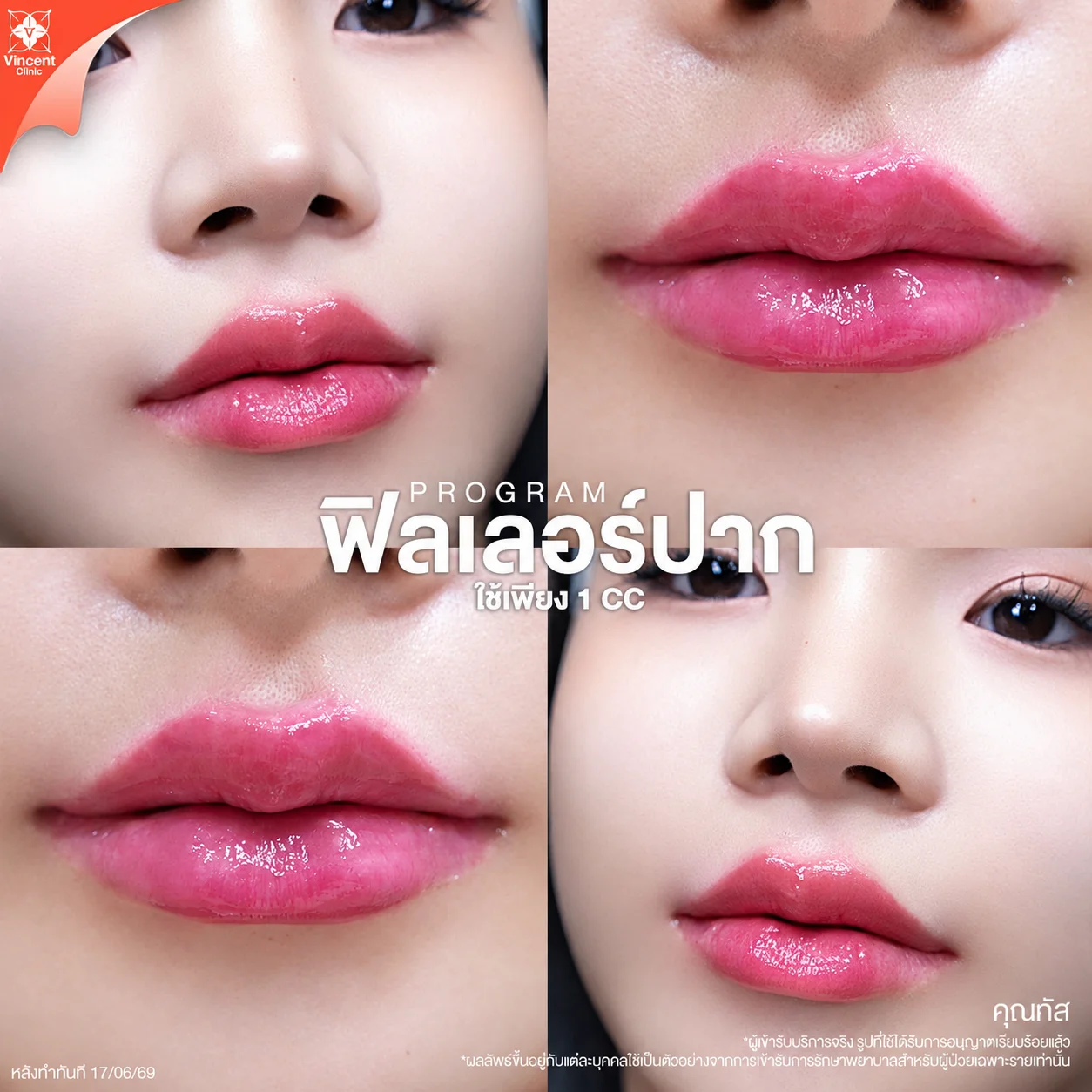 รีวิวฟิลเลอร์ปาก 1cc