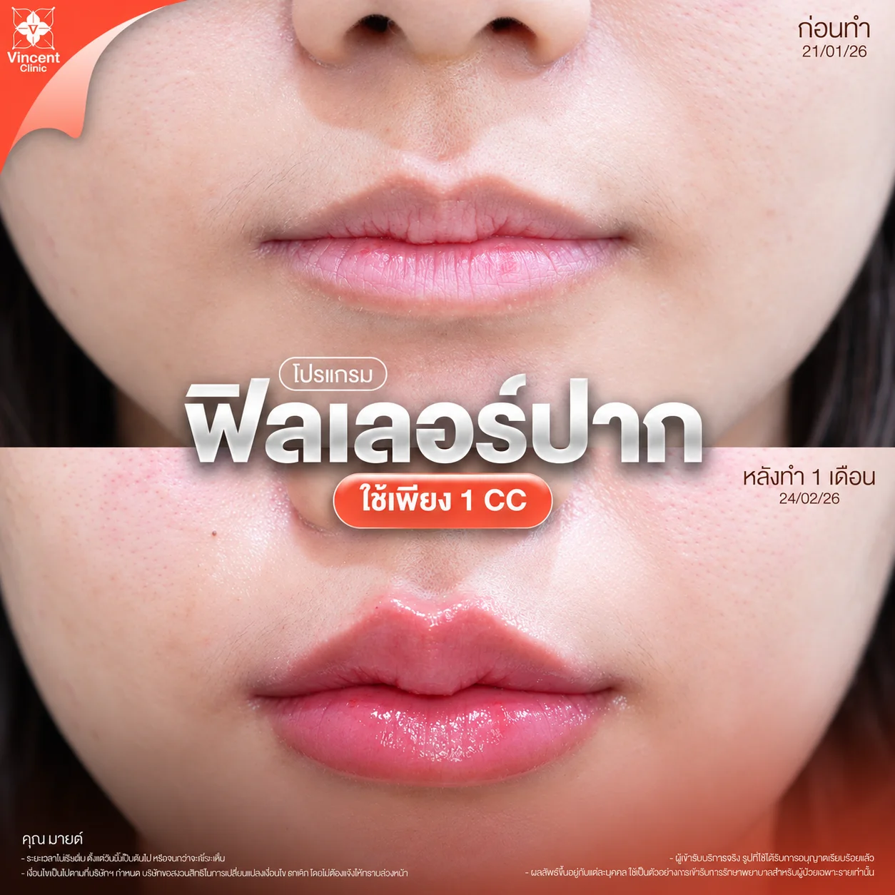 รีวิวฟิลเลอร์ปาก
